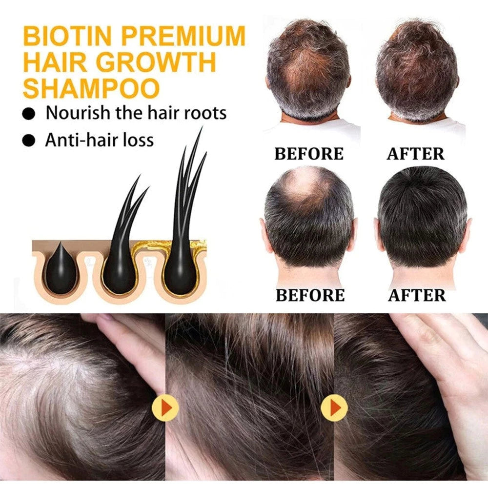 Minoxidil hair growth shampoos